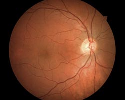 Young healthy retina reference image